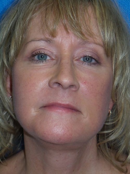 Face/Neck Lift Patient 7