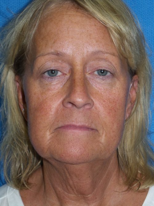 Face/Neck Lift Patient 7
