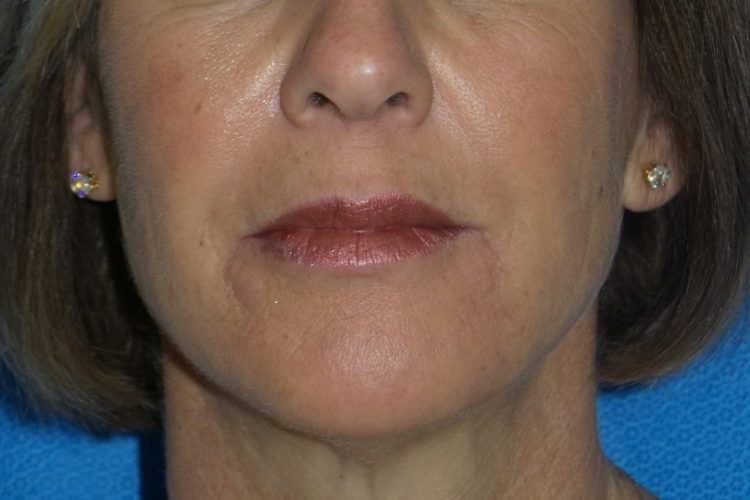 Injectables Patient 6