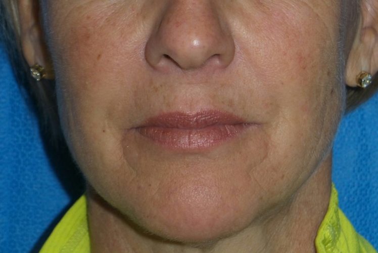 Injectables Patient 6