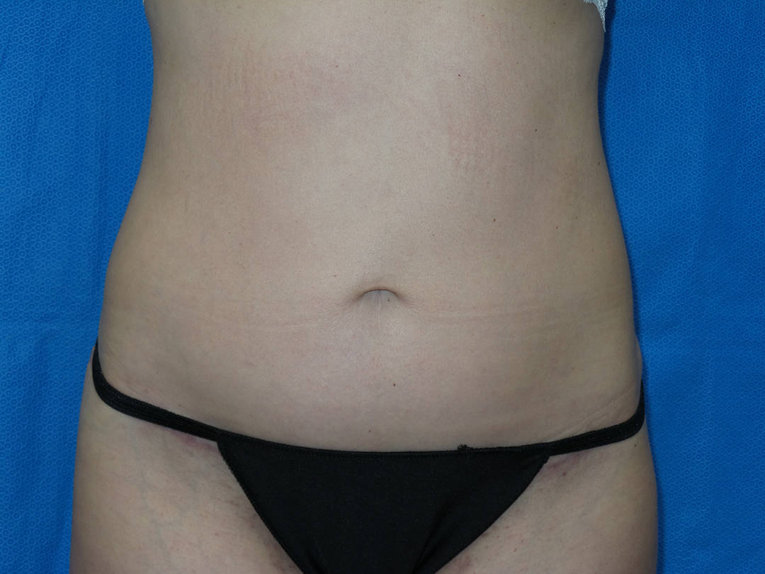 Tummy Tuck Patient