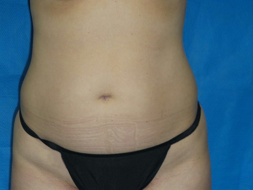 Tummy Tuck Patient