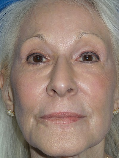 Chemical Peels – Patient 7