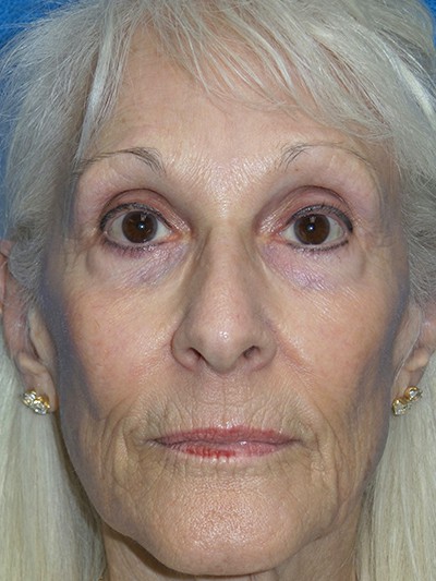 Chemical Peels – Patient 7