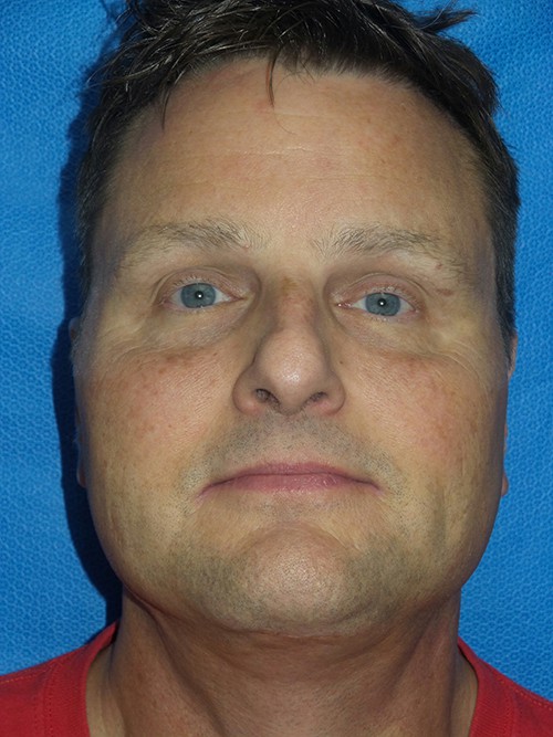 Face/Neck Lift Patient 3