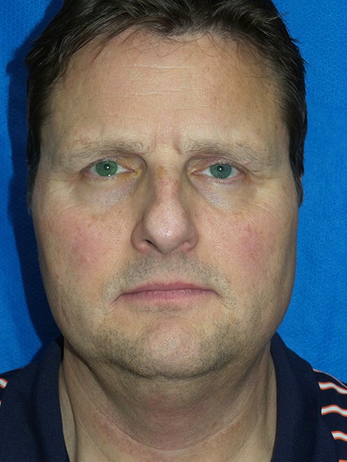 Face/Neck Lift Patient 3