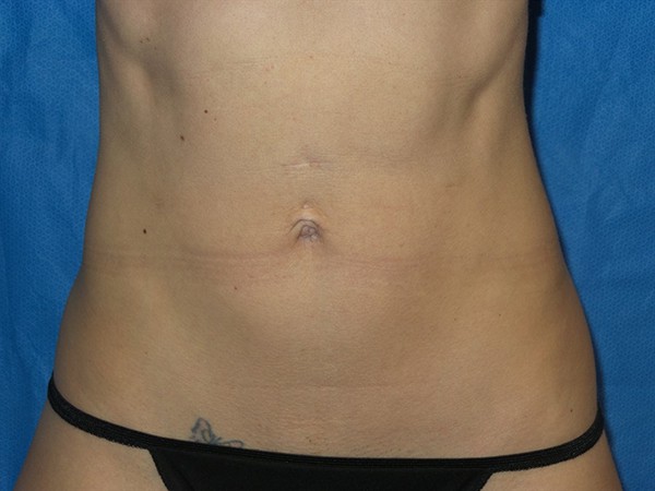 Emsculpt Patient #2