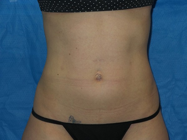 Emsculpt Patient #2