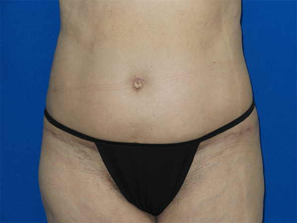 Body Lift Patient 12