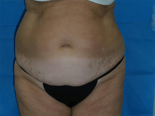 Body Lift Patient 12