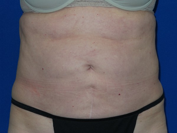 VASER Liposuction Patient 4