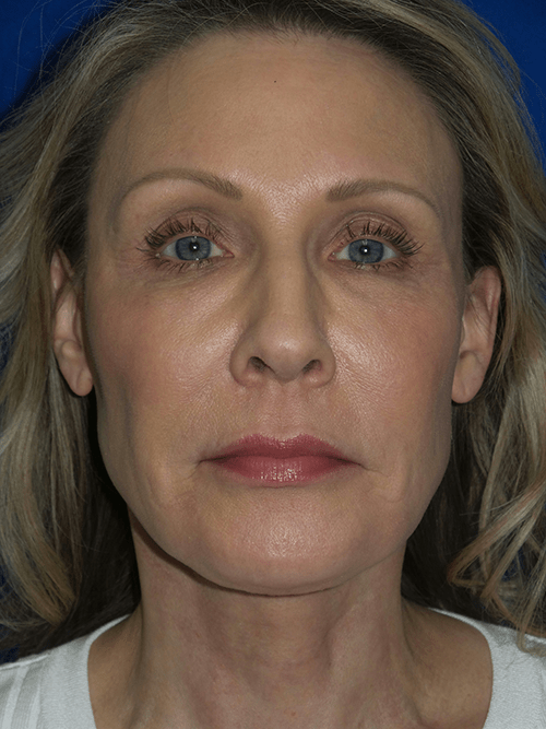 Face/Neck Lift Patient 8