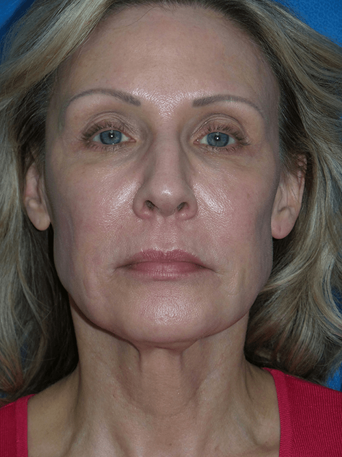 Face/Neck Lift Patient 8