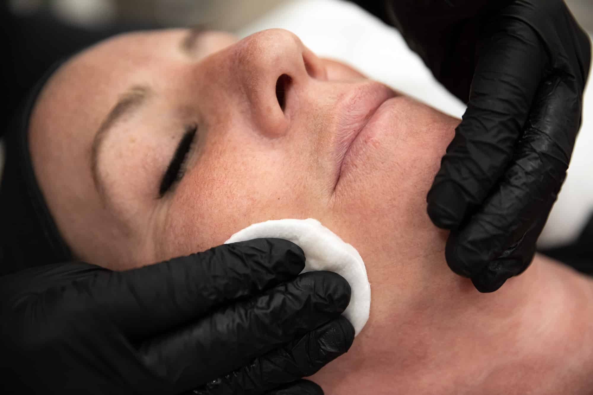 Patient getting chemical peel