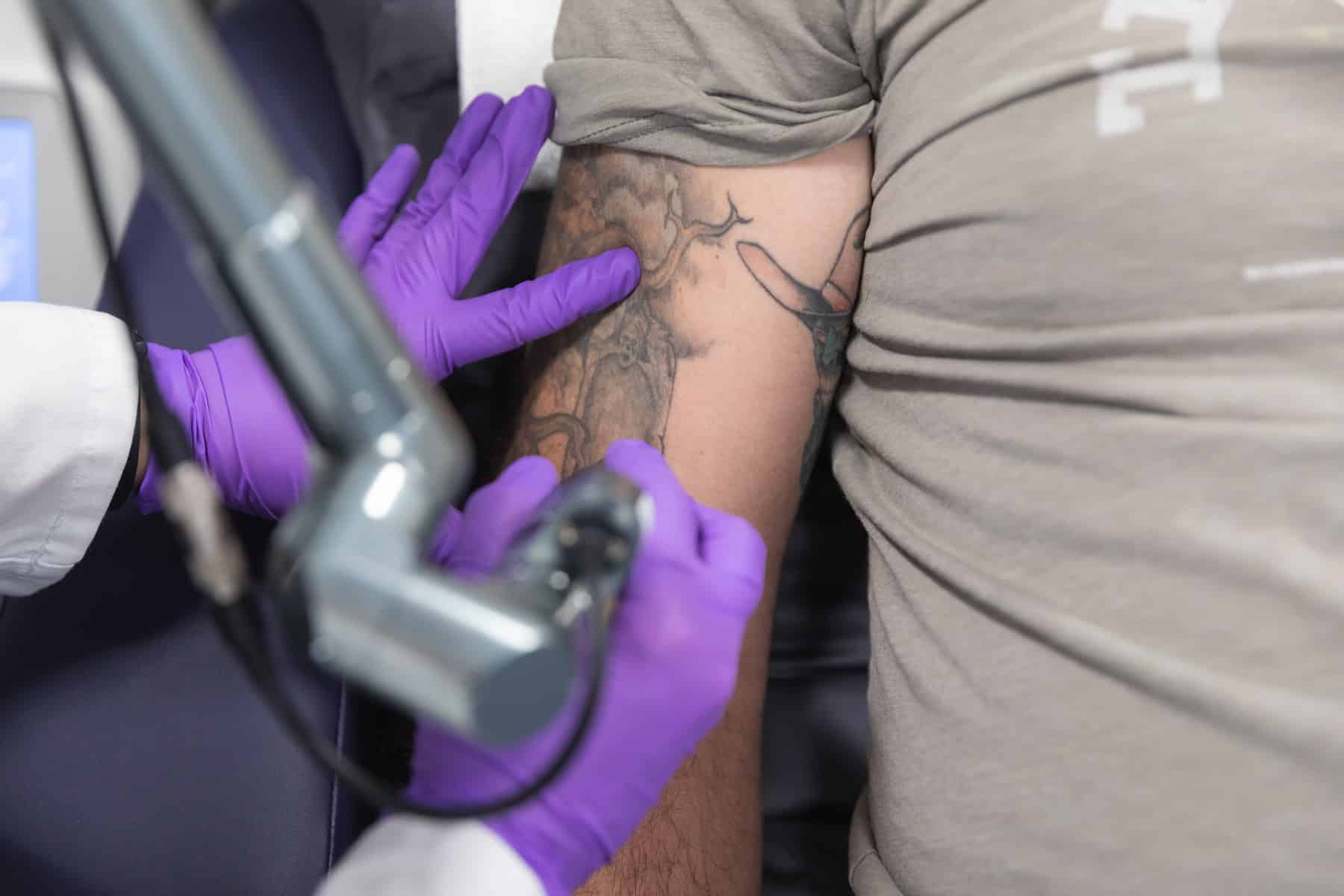 patient getting there tattoo removal