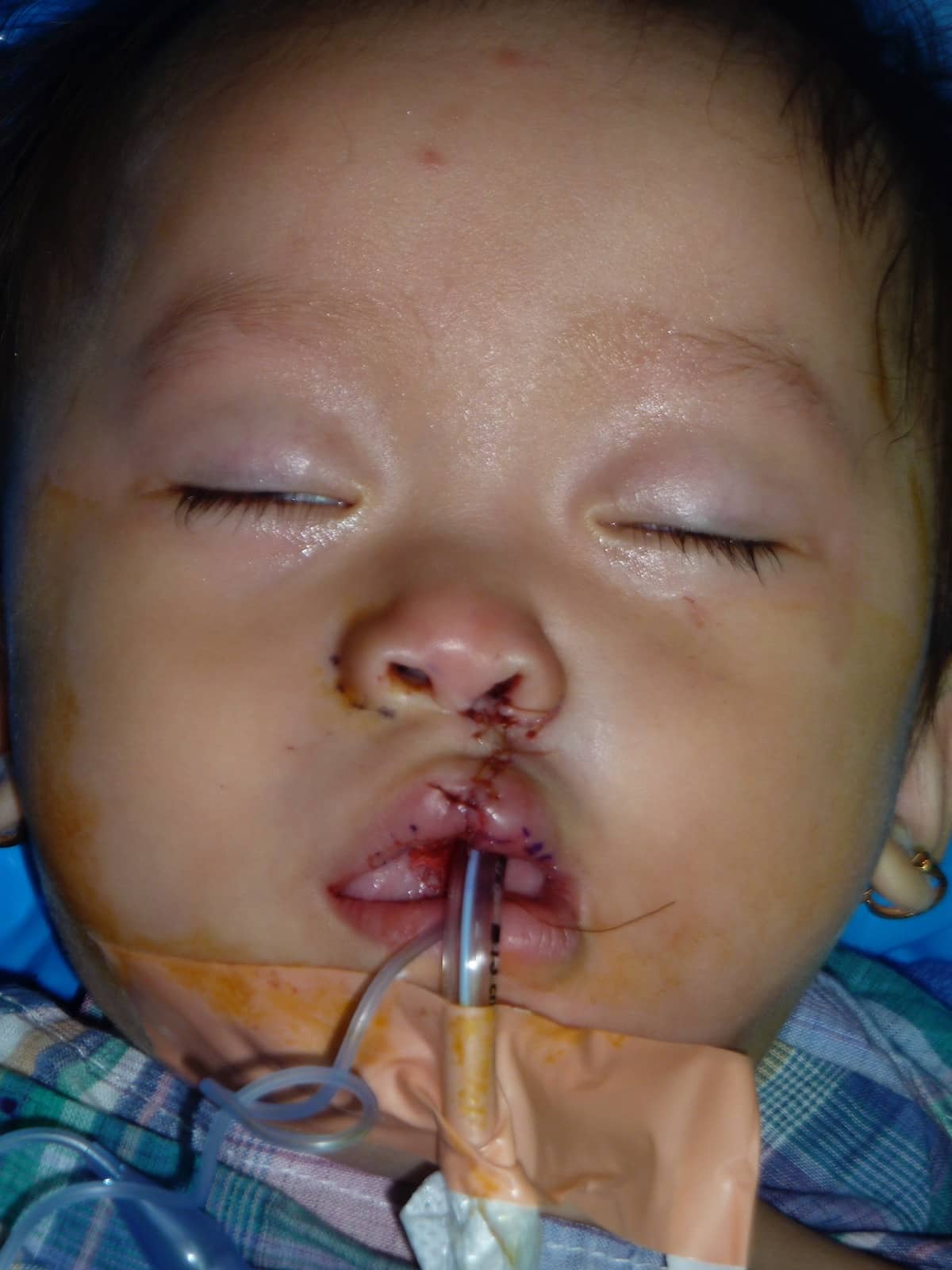 child with lip birth defect